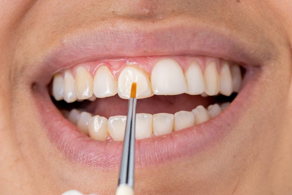 Бондинг композитний